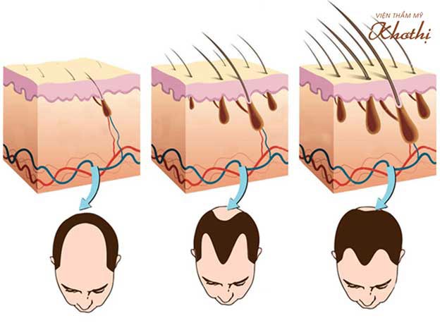 Cấy tóc chính là cách duy nhất để mang tóc trở lại những vùng da đầu đã bị hói