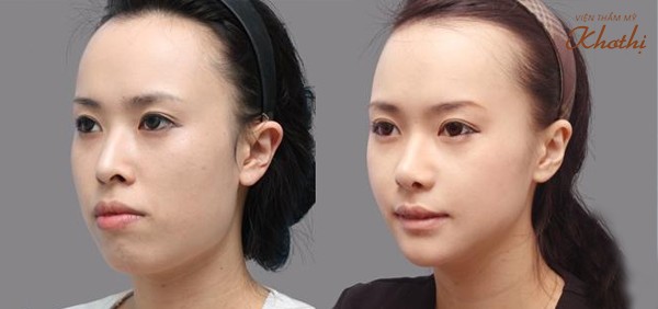 Trước và sau khi Phẫu thuật cắt môi dày thành môi mỏng