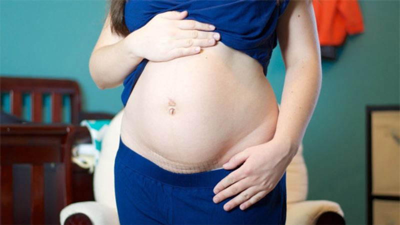 Cách giảm cân hiệu quả sau sinh mổ và cách tập luyện sau sinh mổ