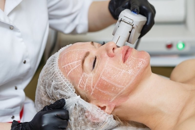 Công nghệ Hifu có thể được dùng để điều trị cho nhiều vùng da khác nhau trên gương mặt.