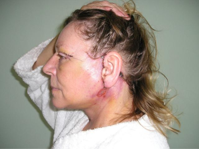 Nhiễm trùng nghiêm trọng sau khi căng da mặt bằng chỉ không tiêu.